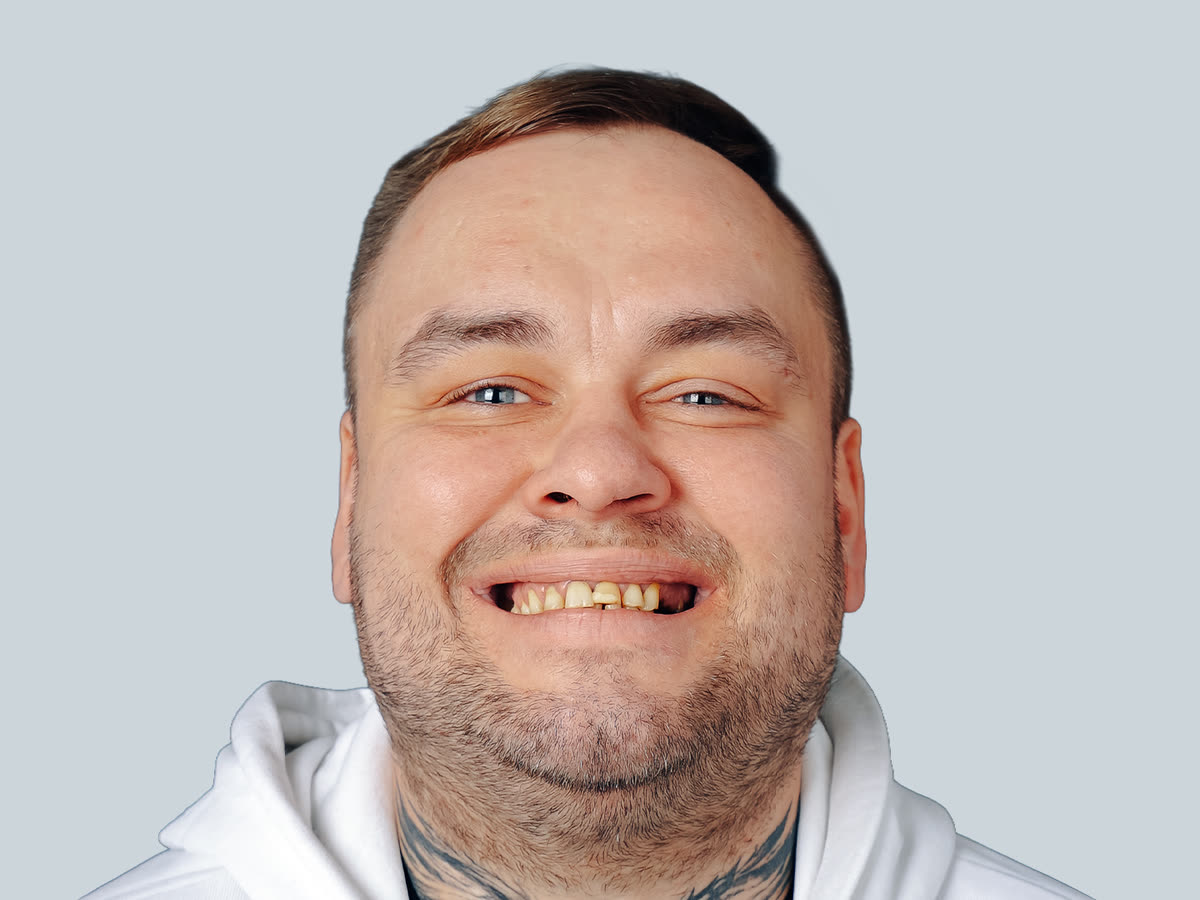 الابتسامة قبل قشور E-max · تجميل الابتسامة — المريض Kamil من بولندا